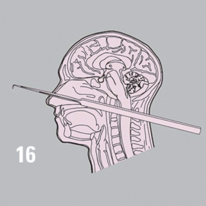 ابزار جراحی مغز و اعصاب، لامینکتومی